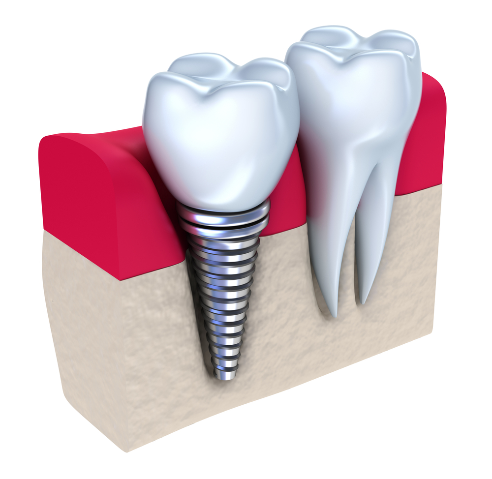 DentalImplant.jpg