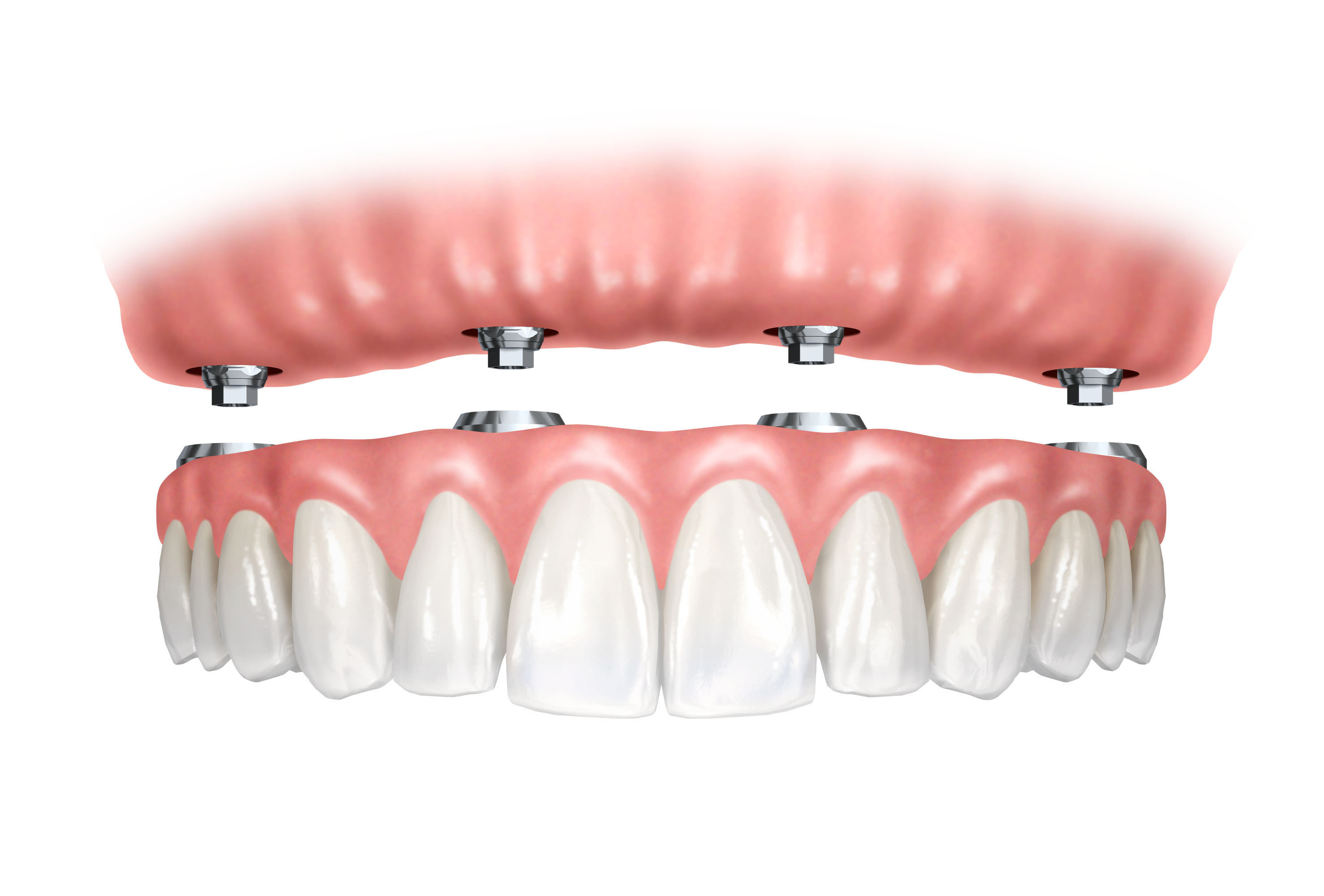 Implant-retained-denture.jpg